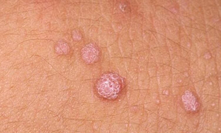 Ο HPV οδηγεί στην εμφάνιση δερματικών θηλωμάτων